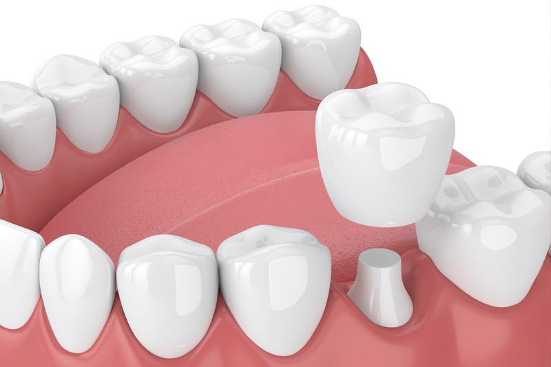 Dental Crowns in Ridgefield