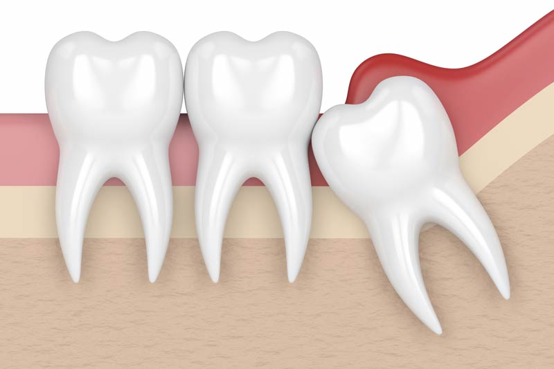 Wisdom Tooth Removal in Ridgefield
